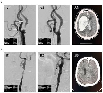 Perioperative Blood Pressure Control in Carotid Artery Stenosis Patients With Carotid Angioplasty Stenting: A Retrospective Analysis of 173 Cases